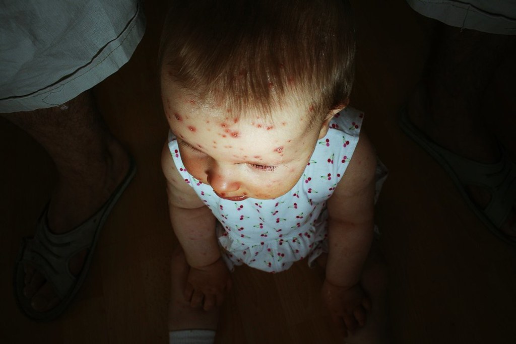 Cara Mengatasi Rasa Gatal pada Cacar Air Anak