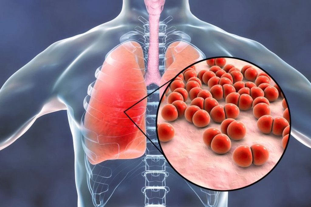 Ilustrasi Pneumonia, Cara Mencegah Pneumonia